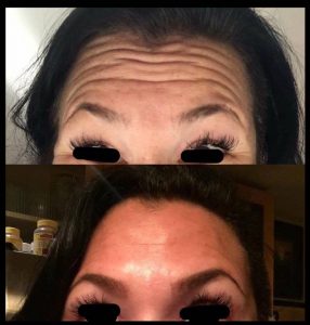Forehead Wrinkle Treatment