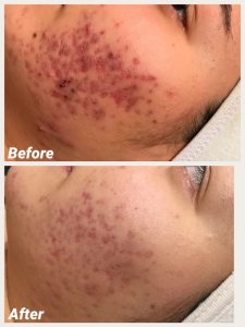Acne Treatment, Before & After