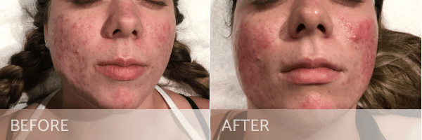 Acne Treatment Before After