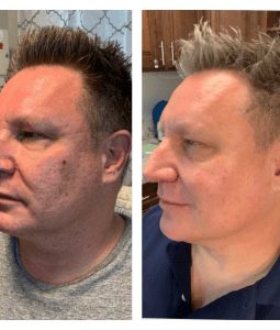 Men's Skin Rejuvenation Before & After