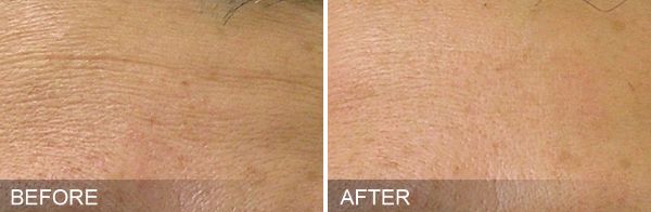 Hydrafacial Treatment, Before & After