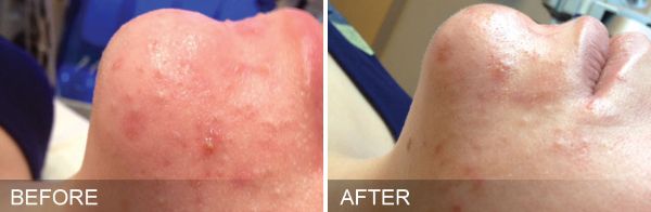 Hydrafacial Treatment, Before & After