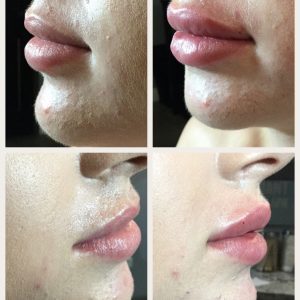 Lip Fillers Before After